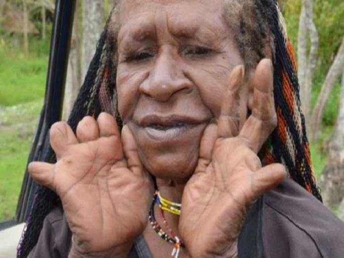 womens of this trib has to cut their fingers after death of family member | धक्कादायक! कुटुंबातील सदस्याचा मृत्यू झाल्यावर महिलांना कापावी लागतात हाताची बोटं womens of this trib has to cut their fingers after death of family member | धक्कादायक! कुटुंबातील सदस्याचा मृत्यू झाल्यावर महिलांना कापावी लागतात हाताची बोटं