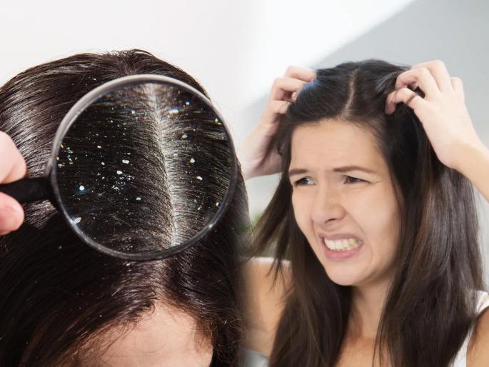 continuously itching your head? Instead of getting irritated by constant itching, try these 4 simple remedies | खराखरा डोकं खाजवताय? सततच्या खाजेमुळे चिडचिड करण्यापेक्षा करा हे ४ सोपे उपाय, कोंडा आणि खाज दोन्हीवर रामबाण