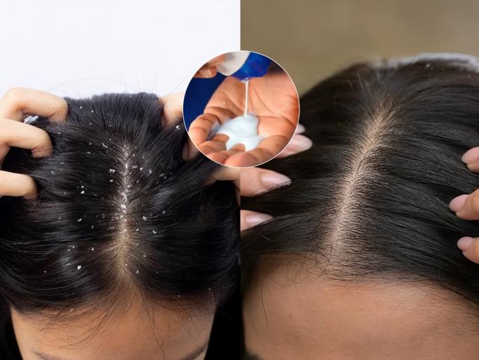 natural home remedy to remove dandruff before washing hair how to treat itchy scalp and scabs caused by dandruff | कोंड्यामुळे टाळूला खाज येते- जखमा होतात-खपल्या धरतात? केस धुण्यापूर्वी १ काम करा, कोंडा जाणारच
