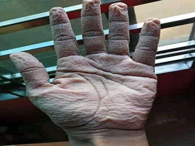 Coronavirus ias share hand of a doctor after removing his medical suit after 10 hours of duty | रिअल हिरो! सतत १० तास काम केल्यानंतर डॉक्टरांचे 'असे' हात पाहून IAS अधिकारी म्हणाले...