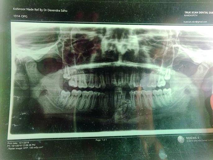 Jara hatke: A 20-year-old youth has 52 teeth! | Jara hatke : २० वर्षीय युवकाला ५२ दात !