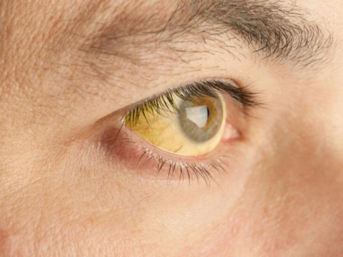 Nagpur Maminpura area people suffered from jaundice,gastro | नागपुरातील मोमिनपुरा परिसर कावीळ, गॅस्ट्रोच्या विळख्यात