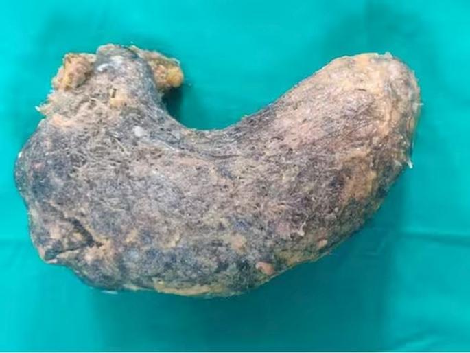 He was desperate to eat his own hair; 100 grams of hair removed from the stomach of a ten-year-old girl | स्वत:चेच केस खाणे बेतले होते जिवावर; दहा वर्षांच्या मुलीच्या पोटातून काढले १०० ग्रॅम केस He was desperate to eat his own hair; 100 grams of hair removed from the stomach of a ten-year-old girl | स्वत:चेच केस खाणे बेतले होते जिवावर; दहा वर्षांच्या मुलीच्या पोटातून काढले १०० ग्रॅम केस