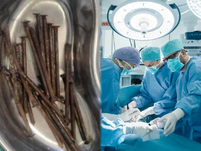 angry with father in gwalior son swallowed 27 nails removed after two and half hours operation | बापरे! वडील ओरडल्याने एकुलत्या एका मुलाने गिळले तब्बल 27 खिळे; मग झालं असं काही... angry with father in gwalior son swallowed 27 nails removed after two and half hours operation | बापरे! वडील ओरडल्याने एकुलत्या एका मुलाने गिळले तब्बल 27 खिळे; मग झालं असं काही...