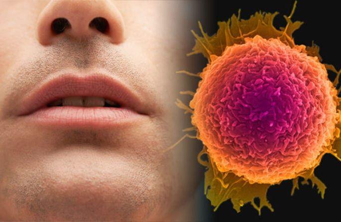 Nagpur has overtaken Pune and Aurangabad in oral cancer | मुखाच्या कर्करोगात नागपूरने पुणे, औरंगाबादला टाकले मागे