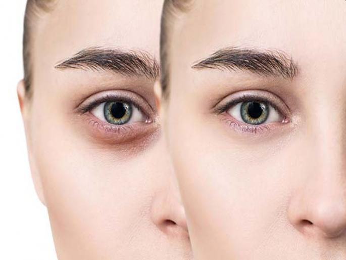 How remove dark circles by using home remedies myb | त्वचेवरील डार्क सर्कल्स दूर करण्यासाठी सुट्टीचा फायदा 'असा' करून घ्या.... How remove dark circles by using home remedies myb | त्वचेवरील डार्क सर्कल्स दूर करण्यासाठी सुट्टीचा फायदा 'असा' करून घ्या....