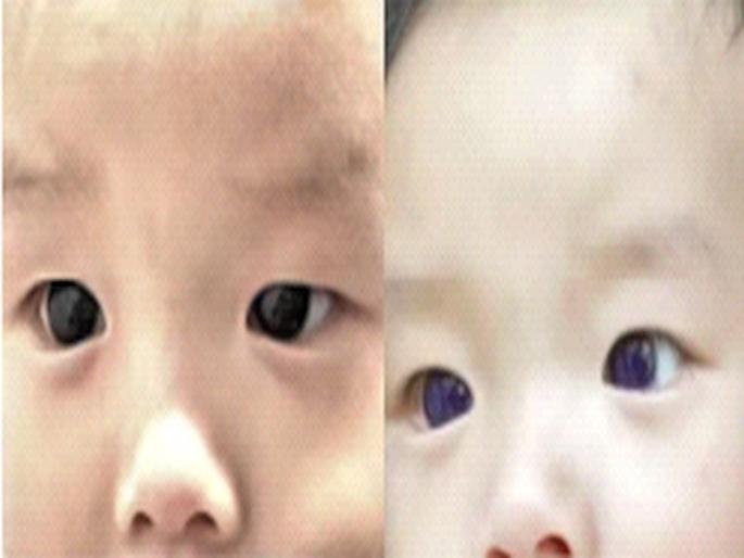 Children's eye color changed due to medication; Strange incident in Thailand during treatment of Corona | औषधांमुळे बदलला मुलाच्या डोळ्यांचा रंग; कोरोनाच्या उपचारादरम्यान थायलंडमध्ये विचित्र घटना Children's eye color changed due to medication; Strange incident in Thailand during treatment of Corona | औषधांमुळे बदलला मुलाच्या डोळ्यांचा रंग; कोरोनाच्या उपचारादरम्यान थायलंडमध्ये विचित्र घटना