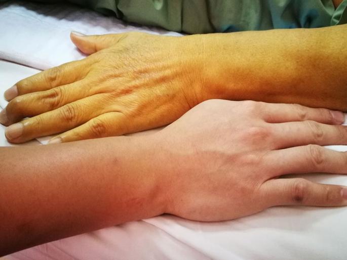 Must eat these things in case of jaundice | कावीळ झाल्यावर कसा आहार घ्यावा? जाणून घ्या Must eat these things in case of jaundice | कावीळ झाल्यावर कसा आहार घ्यावा? जाणून घ्या