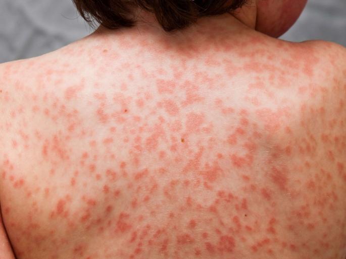 know all about coronavirus Kawasaki disease symptoms in children and its treatment | Kawasaki Disease: कावासाकीचं कोरोनाशी काय आहे 'कनेक्शन'?; जाणून घ्या या आजाराबद्दल सर्व काही...