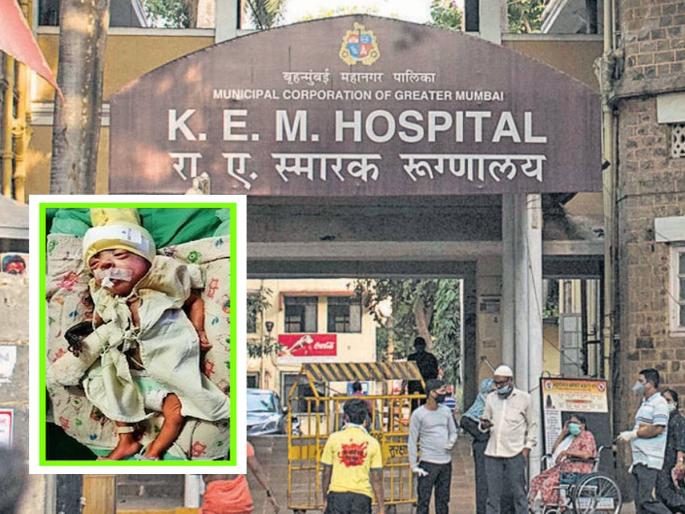 A 52-day-old baby's hand had to be amputated due to the carelessness of KEM Hospital | केईएम हाॅस्पिटलच्या बेफिकीरीमुळे ५२ दिवसांच्या चिमुकल्याचा हात कापावा लागला A 52-day-old baby's hand had to be amputated due to the carelessness of KEM Hospital | केईएम हाॅस्पिटलच्या बेफिकीरीमुळे ५२ दिवसांच्या चिमुकल्याचा हात कापावा लागला