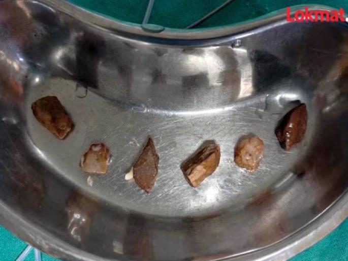 6 stones were found in the esophagus of a four-month-old baby girl; With the efforts of the doctor, the girl got a new life | बापरे! चार महिन्यांच्या चिमुकलीच्या अन्ननलिकेत आढळले तब्बल ६ खडे; डॉक्टरांसह सर्वांनाच धक्का 6 stones were found in the esophagus of a four-month-old baby girl; With the efforts of the doctor, the girl got a new life | बापरे! चार महिन्यांच्या चिमुकलीच्या अन्ननलिकेत आढळले तब्बल ६ खडे; डॉक्टरांसह सर्वांनाच धक्का