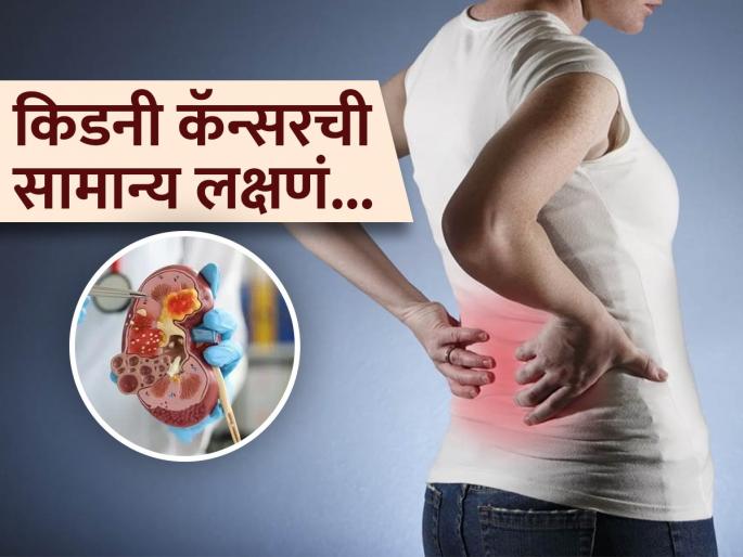 World Kidney Cancer Day : Doctor tells why kidney cancer often detected late | अनेकदा वेळ निघून गेल्यावरच का होतं किडनी कॅन्सरचं निदान? ‘या’ गोष्टीकडे वेळीच लक्ष द्या..