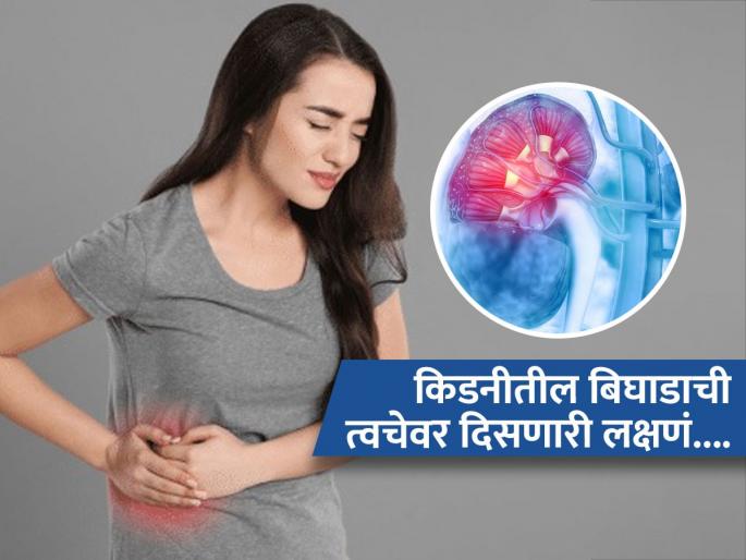 Signs of kidney damage which can be seen on skin | किडनीचा आजार असेल तर त्वचेवर दिसतात ‘ही’ लक्षणं, तुमची त्वचा देते धोक्याचा इशारा