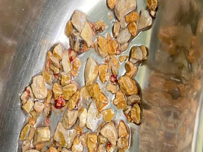 206 kidney stones removed from 56 year old man through keyhole surgery in Hyderabad | अरे बाप रे बाप! रूग्णाच्या किडनीतून काढले २०६ किडनी स्टोन, एका चुकीमुळे त्याला हे पडलं इतकं महागात 206 kidney stones removed from 56 year old man through keyhole surgery in Hyderabad | अरे बाप रे बाप! रूग्णाच्या किडनीतून काढले २०६ किडनी स्टोन, एका चुकीमुळे त्याला हे पडलं इतकं महागात