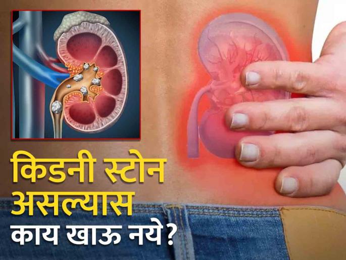 Kidney stone patient should avoid eating these 3 things the problem may increase | किडनी स्टोनच्या रूग्णांनी चुकूनही खाऊ नये 'या' ३ गोष्टी, अधिक वाढू शकते समस्या! Kidney stone patient should avoid eating these 3 things the problem may increase | किडनी स्टोनच्या रूग्णांनी चुकूनही खाऊ नये 'या' ३ गोष्टी, अधिक वाढू शकते समस्या!