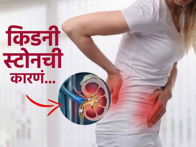 Common symptoms of kidney stones in women | महिलांमध्ये किडनी स्टोनची दिसतात 'ही' लक्षणं, जाणून घ्या कारणं आणि काही घरगुती उपाय!