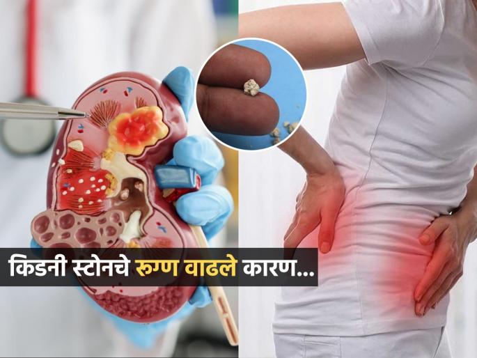 Kidney stone cases increase during monsoon in Mumbai Mumbai doctors warn | पावसाळ्यात मुंबईत किडनी स्टोनच्या रूग्णांमध्ये वाढ; डॉक्टरांनी सांगितली कारणं, लक्षणं आणि उपाय