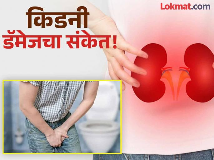 Change in urine color can be kidney damage symptoms | सकाळी लघवीचा रंग 'असा' दिसेल तर वेळीच व्हा सावध, आतल्या आत डॅमेज होऊ शकतात किडनी! Change in urine color can be kidney damage symptoms | सकाळी लघवीचा रंग 'असा' दिसेल तर वेळीच व्हा सावध, आतल्या आत डॅमेज होऊ शकतात किडनी!