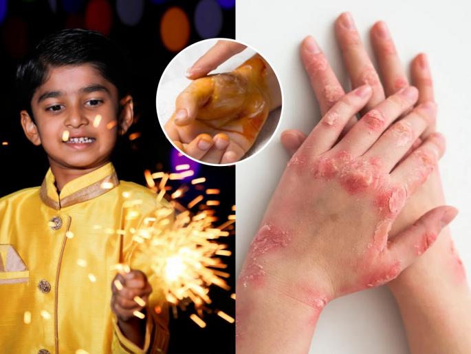 how to heal hand burn from Diwali crackers at Home first aid steps for minor burns during Diwali celebration | Diwali 2025 : दिवाळीत फटाक्यांमुळे हात भाजला- चटका बसला? लगेच करा 'या' गोष्टी - आग होईल कमी