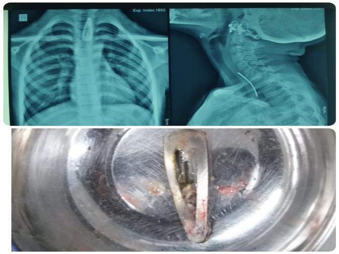 Hairpin stuck in esophagus, seven year old girl saved after successful surgery in cpr hospital kolhapur | अन्ननलिकेत अडकली केसांत घालायची पिन, यशस्वी शस्त्रक्रियेनंतर सात वर्षाच्या बालिकेला मिळाले जीवदान Hairpin stuck in esophagus, seven year old girl saved after successful surgery in cpr hospital kolhapur | अन्ननलिकेत अडकली केसांत घालायची पिन, यशस्वी शस्त्रक्रियेनंतर सात वर्षाच्या बालिकेला मिळाले जीवदान