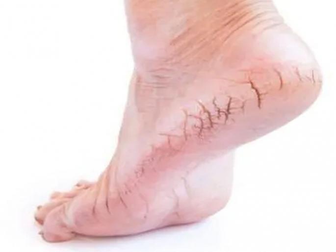 how to prevent from cracked heels in winter | हिवाळ्यात टाचांना भेगा पडण्याची समस्या अशी करा दूर!