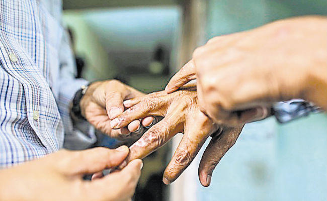 Kalaash Shinde's demand to pay leprosy five thousand rupees | कुष्ठपीडितांना पाच हजारांचे मानधन द्या, कैलास शिंदे यांची मागणी Kalaash Shinde's demand to pay leprosy five thousand rupees | कुष्ठपीडितांना पाच हजारांचे मानधन द्या, कैलास शिंदे यांची मागणी