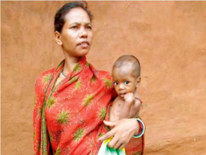 Hunger and gluttony; The double burden of malnutrition | भूक आणि खादाडी; कुपोषणाचा दुहेरी भार