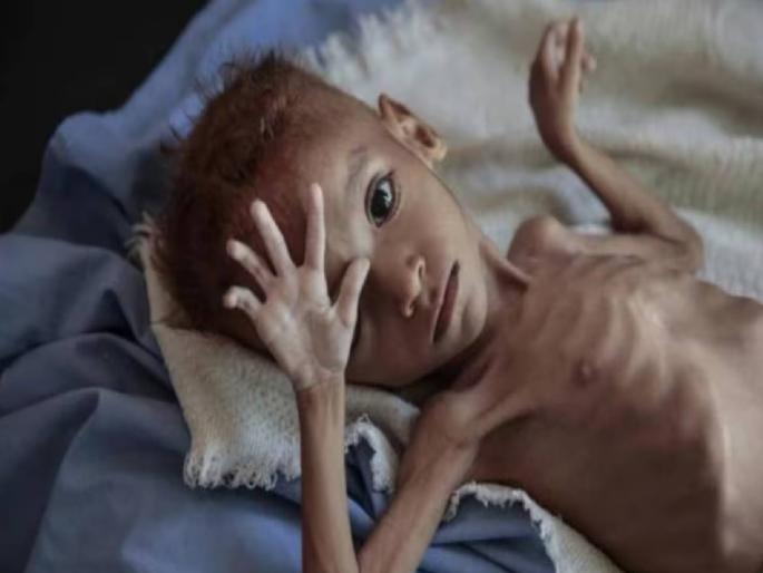 Who will save these children? Whose responsibility? In Uttar Pradesh 48 percent and in Maharashtra 47.7 percent children are anemic | या मुलांना वाचवणार कोण ? जबाबदारी कोणाची ? उत्तर प्रदेशात ४८ तर महाराष्ट्रात ४७.७ टक्के मुले ॲनिमिक Who will save these children? Whose responsibility? In Uttar Pradesh 48 percent and in Maharashtra 47.7 percent children are anemic | या मुलांना वाचवणार कोण ? जबाबदारी कोणाची ? उत्तर प्रदेशात ४८ तर महाराष्ट्रात ४७.७ टक्के मुले ॲनिमिक