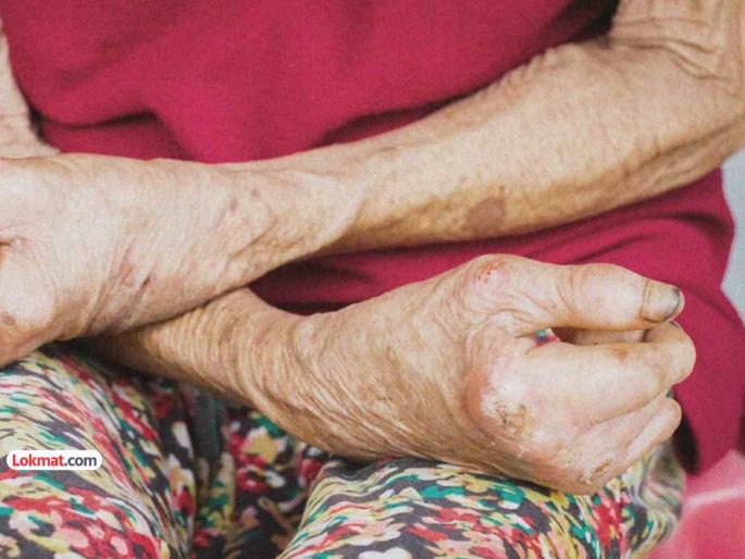 Once diagnosed with leprosy registration is mandatory Public Health Department decision | कुष्ठरोगाचे निदान झाले रे झाले की, रुग्णनाेंद बंधनकारक; सार्वजनिक आरोग्य विभागाचा निर्णय