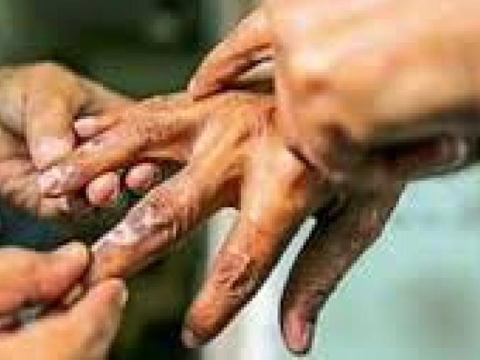 207 new leprosy patients found in Kolhapur | चिंताजनक! कोल्हापुरात आढळले नवीन २०७ कुष्ठरुग्ण 207 new leprosy patients found in Kolhapur | चिंताजनक! कोल्हापुरात आढळले नवीन २०७ कुष्ठरुग्ण