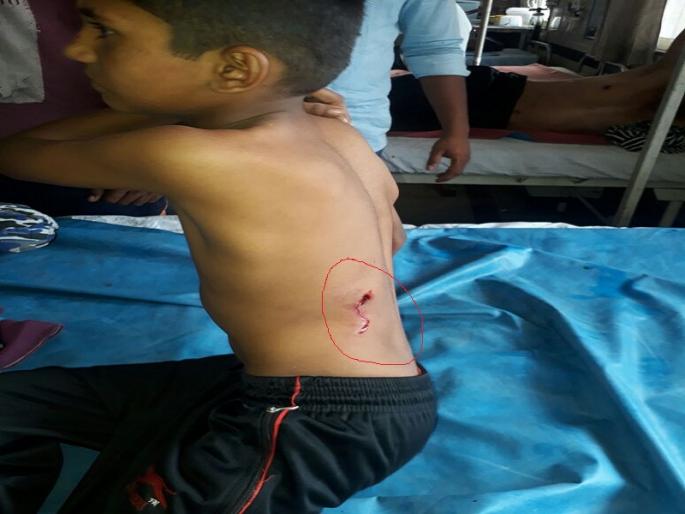 Bitten for many dogs taken by pounded dogs | पिसाळलेल्या कुत्र्यांनी घेतला ९ जणांना चावा  Bitten for many dogs taken by pounded dogs | पिसाळलेल्या कुत्र्यांनी घेतला ९ जणांना चावा