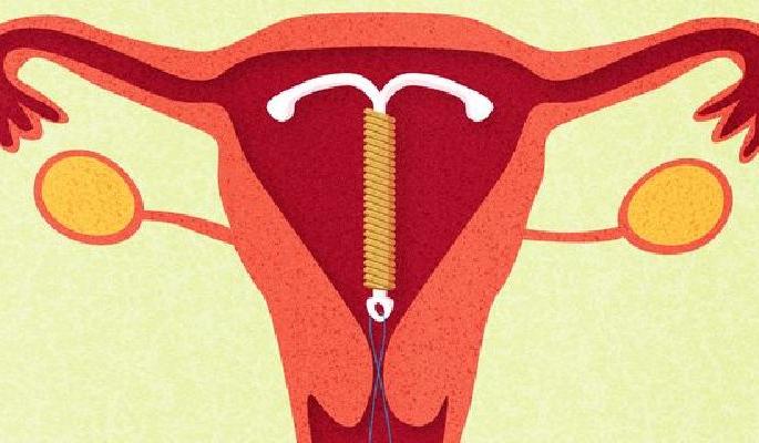 Copper-T does not affect the hormonal cycle at all said expert | कॉपर-टीमुळे हॉर्मोनल सायकलवर परिणाम होत नाहीच Copper-T does not affect the hormonal cycle at all said expert | कॉपर-टीमुळे हॉर्मोनल सायकलवर परिणाम होत नाहीच