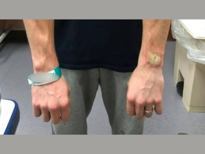 Law Suit Against Google Owned Fitbit Overheat And Cause Burns To Customers   | Fitbit Smartwatch घेणं पडू शकतं महागात! कॅलरीजच्या ऐवजी जळत आहेत युजर्सचे हात   Law Suit Against Google Owned Fitbit Overheat And Cause Burns To Customers   | Fitbit Smartwatch घेणं पडू शकतं महागात! कॅलरीजच्या ऐवजी जळत आहेत युजर्सचे हात