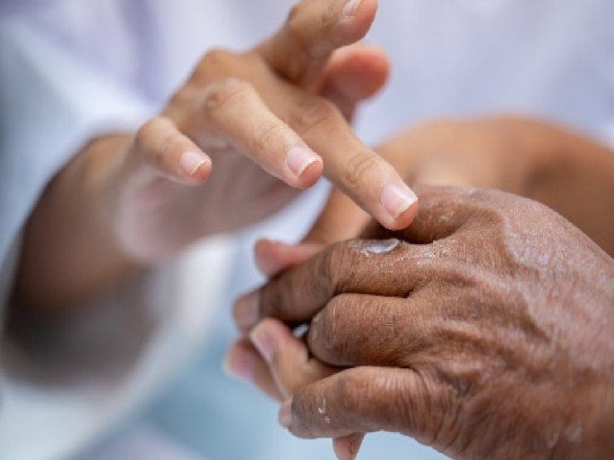 Chhatrapati Sambhajinagar district currently has 253 active leprosy patients, patient search campaign from November | छत्रपती संभाजीनगर जिल्ह्यात सद्य:स्थितीत २५३ क्रियाशील कुष्ठरोगी, नोव्हेंबरपासून रुग्ण शोधमोहीम Chhatrapati Sambhajinagar district currently has 253 active leprosy patients, patient search campaign from November | छत्रपती संभाजीनगर जिल्ह्यात सद्य:स्थितीत २५३ क्रियाशील कुष्ठरोगी, नोव्हेंबरपासून रुग्ण शोधमोहीम