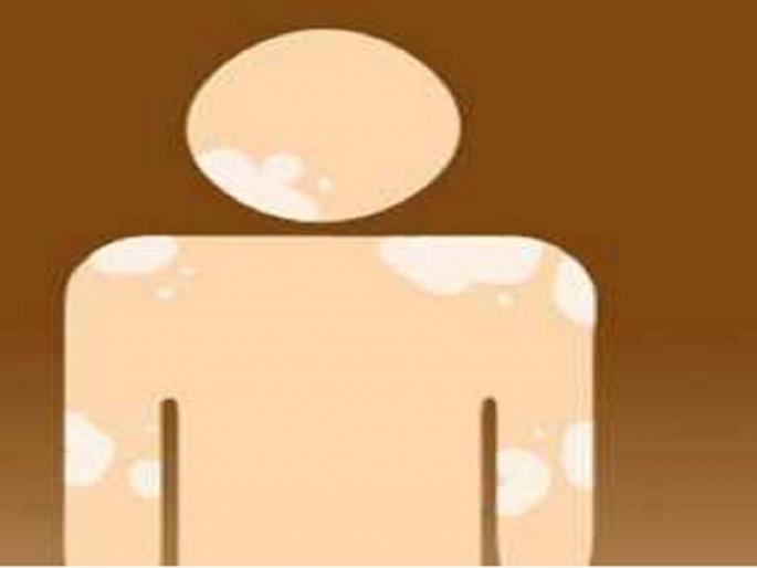 Osmanabad district has a 10% increase in leprosy population | उस्मानाबाद जिल्ह्यात कुष्ठरूग्णांच्या संख्येत दहा टक्क्यांनी वाढ Osmanabad district has a 10% increase in leprosy population | उस्मानाबाद जिल्ह्यात कुष्ठरूग्णांच्या संख्येत दहा टक्क्यांनी वाढ