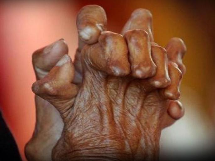 Maharashtra ranked fourth in leprosy; Most patients in four districts | कुष्ठरोगात महाराष्ट्र चौथ्या स्थानी; सर्वाधिक रुग्ण चार जिल्ह्यात Maharashtra ranked fourth in leprosy; Most patients in four districts | कुष्ठरोगात महाराष्ट्र चौथ्या स्थानी; सर्वाधिक रुग्ण चार जिल्ह्यात