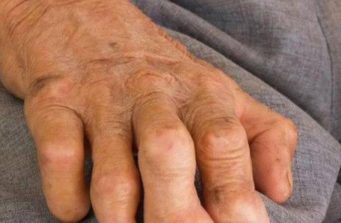 Leprosy NCDR at 5.41 ratio per 10,000 patients | कृष्ठरोगाचा एनसीडीआर ५.४१ वर; दहा हजार रुग्णांमागे ०.४४ प्रमाण Leprosy NCDR at 5.41 ratio per 10,000 patients | कृष्ठरोगाचा एनसीडीआर ५.४१ वर; दहा हजार रुग्णांमागे ०.४४ प्रमाण