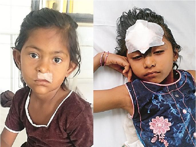 ... and matched lips gets smiles; Lions Plastic Surgery Camp gives new life to patient | ...आणि दुभंगलेले ओठ जुळले; लायन्स प्लास्टिक सर्जरी शिबीर ठरते गरीब रुग्णांसाठी वरदान  ... and matched lips gets smiles; Lions Plastic Surgery Camp gives new life to patient | ...आणि दुभंगलेले ओठ जुळले; लायन्स प्लास्टिक सर्जरी शिबीर ठरते गरीब रुग्णांसाठी वरदान