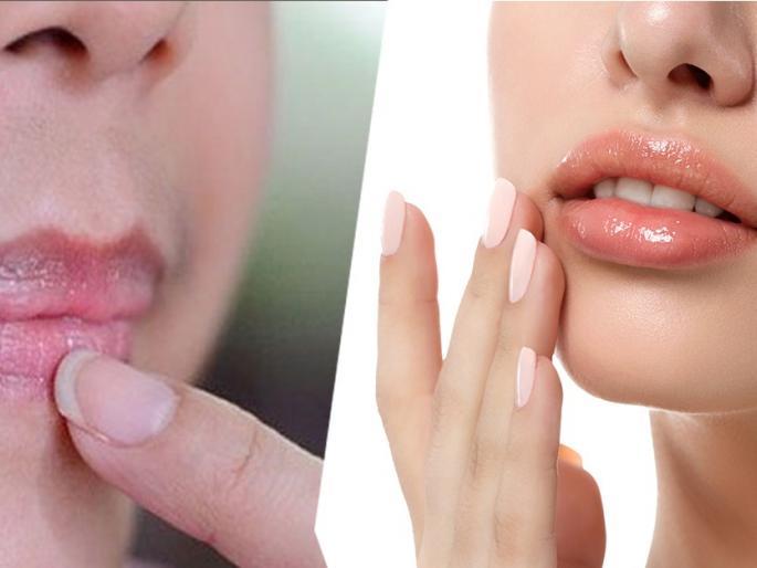 Beauty tips: Home remedies for the pigmentation or darkness on upper lip... | Beauty Tips: वरचा ओठ जास्त काळा पडलाय? हे घरगुती उपाय करा, काळपटपणा कमी होतो!