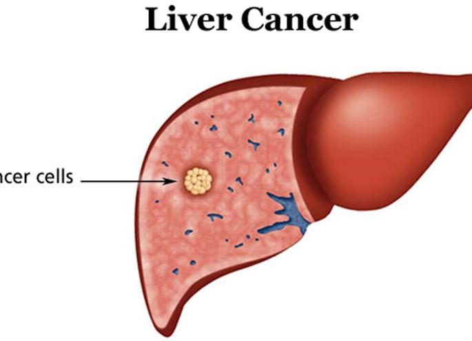 The fifth reason for death is Liver Cancer: Dr. Gaurav Gupta | मृत्यूचे पाचवे कारण लिव्हर कॅन्सर : डॉ. गौरव गुप्ता The fifth reason for death is Liver Cancer: Dr. Gaurav Gupta | मृत्यूचे पाचवे कारण लिव्हर कॅन्सर : डॉ. गौरव गुप्ता