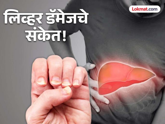 Check the nails of hands and feet this change in shape and color is a sign of liver damage | लगेच चेक करा हात आणि पायांची नखं, आकार-रंगात बदल आहे लिव्हर डॅमेजचा संकेत! Check the nails of hands and feet this change in shape and color is a sign of liver damage | लगेच चेक करा हात आणि पायांची नखं, आकार-रंगात बदल आहे लिव्हर डॅमेजचा संकेत!