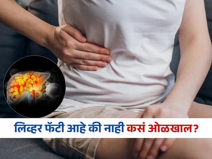 Doctor tells 5 signs of fatty liver you can check at home | फॅटी लिव्हरची लक्षणं कशी ओळखाल? डॉक्टर सांगतात, काय काळजी घ्यायची-नेमकं खायचं काय..
