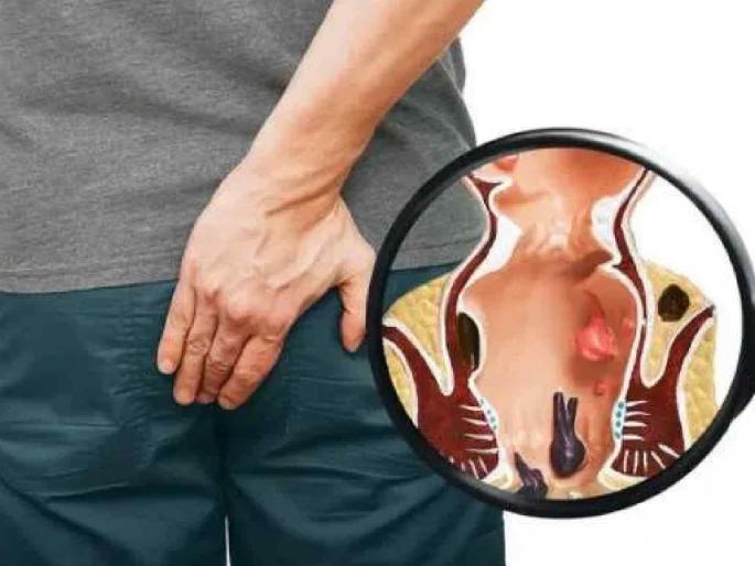 eating spicy food and meeting activities; Risk of hemorrhoids, be careful | मसालेदार पदार्थ खाताय अन् बैठकीची कामे; मूळव्याधीचा धोका, घ्या काळजी