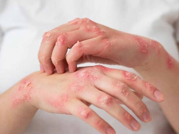 Oh my! Neglected NTDs affect over a billion people every year | बापरे ! दुर्लक्षित असलेल्या 'एनटीडी' आजारामुळे दरवर्षी एक अब्जाहून अधिक लोक प्रभावित