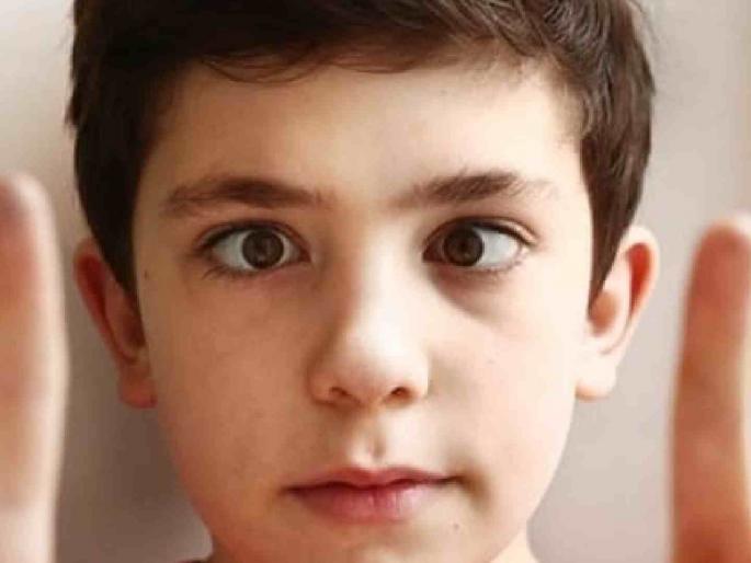 If you also have strabismus, this is how you should treat it. | तुम्हालाही तिरळेपणा असेल तर असा करावा उपचार