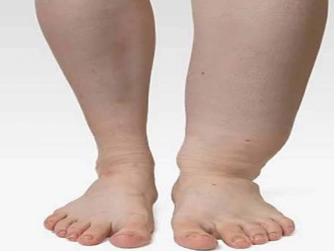 Elephantiasis medicine distribution campaign stopped! Pills started breaking during distribution | हत्तीरोग औषध वितरण मोहीम थांबवली ! वितरण करताना तुटू लागल्या गोळ्या Elephantiasis medicine distribution campaign stopped! Pills started breaking during distribution | हत्तीरोग औषध वितरण मोहीम थांबवली ! वितरण करताना तुटू लागल्या गोळ्या