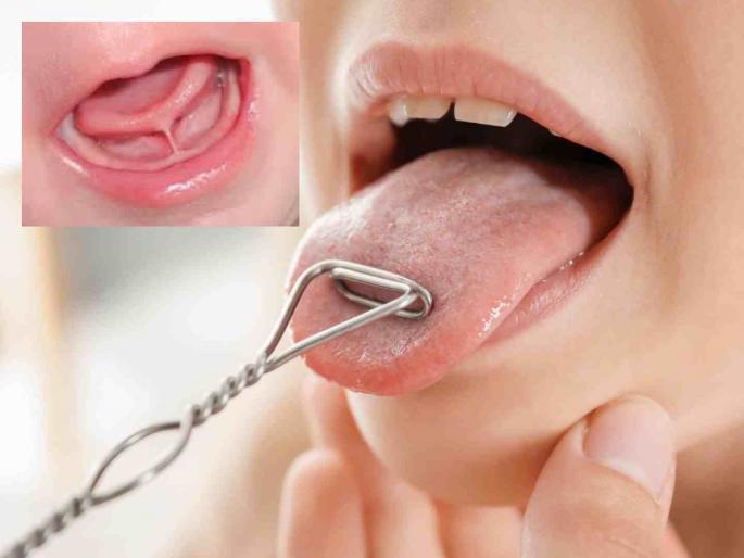 'Tongue tie' will help children speak clearly; Free surgery will be done under the National Child Health Program | 'टंग टाय'नं पोरं बोलतील स्पष्ट ; राष्ट्रीय बाल स्वास्थ्य कार्यक्रमांतर्गत होणार मोफत शस्त्रक्रिया 'Tongue tie' will help children speak clearly; Free surgery will be done under the National Child Health Program | 'टंग टाय'नं पोरं बोलतील स्पष्ट ; राष्ट्रीय बाल स्वास्थ्य कार्यक्रमांतर्गत होणार मोफत शस्त्रक्रिया