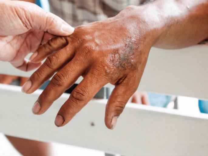 226 new leprosy patients found in Amravati district in a period of seven months | अमरावती जिल्ह्यात सात महिन्यांच्या कालावधीत नव्याने आढळले २२६ कुष्ठरुग्ण