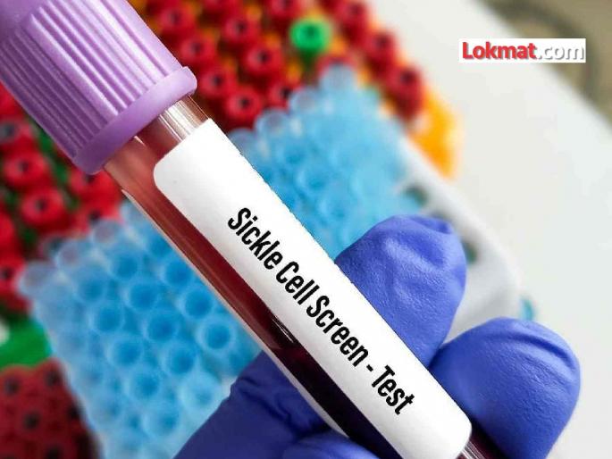 'Arunodaya' campaign to curb sickle cell; Comprehensive screening of 0 to 40 age group in Nagpur district | सिकलसेलला आळा घालण्यासाठी ‘अरुणोदय’ मोहीम; नागपूर जिल्ह्यात ० ते ४० वयोगटाची व्यापक तपासणी 'Arunodaya' campaign to curb sickle cell; Comprehensive screening of 0 to 40 age group in Nagpur district | सिकलसेलला आळा घालण्यासाठी ‘अरुणोदय’ मोहीम; नागपूर जिल्ह्यात ० ते ४० वयोगटाची व्यापक तपासणी