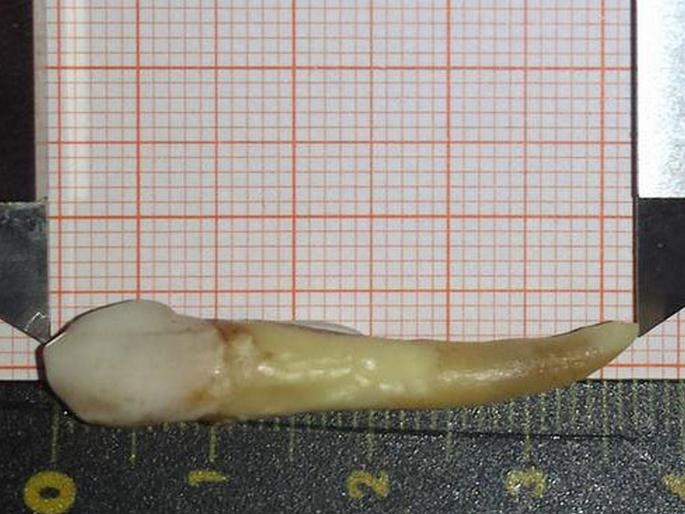 The largest tooth in the world was removed from the mouth of this 'person'! | 'या' व्यक्तीच्या तोंडातून काढण्यात आला जगातला सर्वात मोठा दात, लांबी वाचून व्हाल अवाक्.... The largest tooth in the world was removed from the mouth of this 'person'! | 'या' व्यक्तीच्या तोंडातून काढण्यात आला जगातला सर्वात मोठा दात, लांबी वाचून व्हाल अवाक्....